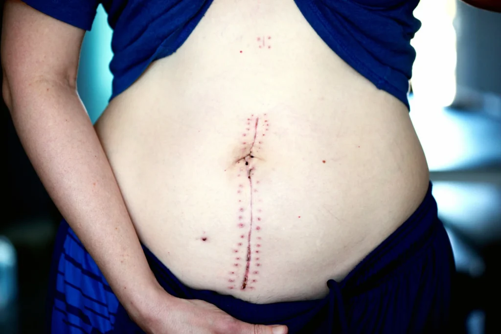 Lymphdrainage nach einer Bauchoperation