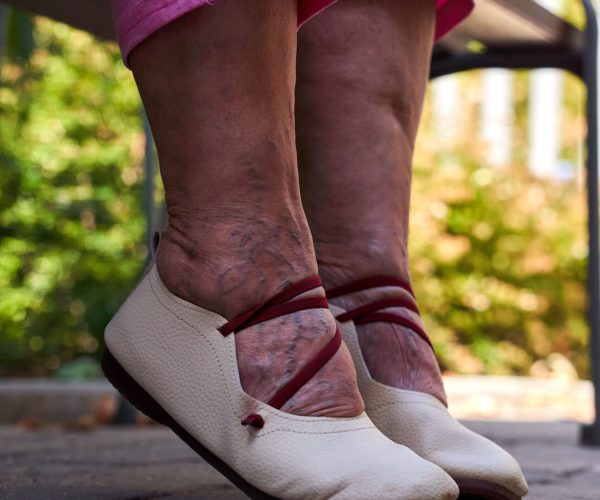 Swollen feet